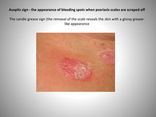 Auspitz sign - the appearance of bleeding spots when psoriasis scales are scraped off
The candle grease sign (the removal of the scale reveals the skin with a glossy grease-
like appearance
 