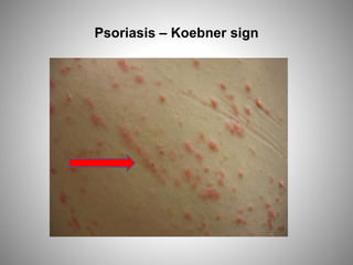 Psoriasis – Koebner sign
 