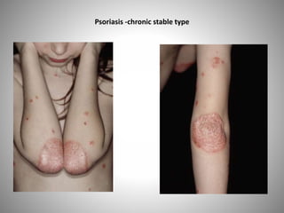 Psoriasis -chronic stable type
 