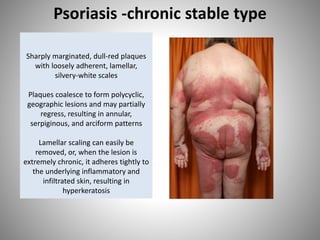 Sharply marginated, dull-red plaques
with loosely adherent, lamellar,
silvery-white scales
Plaques coalesce to form polycyclic,
geographic lesions and may partially
regress, resulting in annular,
serpiginous, and arciform patterns
Lamellar scaling can easily be
removed, or, when the lesion is
extremely chronic, it adheres tightly to
the underlying inflammatory and
infiltrated skin, resulting in
hyperkeratosis
Psoriasis -chronic stable type
 
