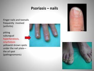 Finger nails and toenails
frequently involved
(arthritis)
pitting
subungual
hyperkeratosis,
onycholysis
yellowish-brown spots
under the nail plate—
the oil spot
(pathognomonic)
Psoriasis – nails
 