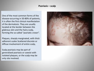 One of the most common forms of the
disease-occurring in 50-80% of patients,
it is often the first clinical manifestation
of the dermatosis. They are usually
located at the border between the
glabrous skin and the hairy scalp,
forming the so called "psoriatic crown".
Plaques, sharply marginated, with thick
adherent scales Scattered discrete or
diffuse involvement of entire scalp,
Scalp psoriasis may be part of
generalized psoriasis or coexist with
isolated plaques, or the scalp may be
only site involved.
Psoriasis – scalp
 