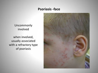 Uncommonly
involved
when involved,
usually associated
with a refractory type
of psoriasis
Psoriasis -face
 