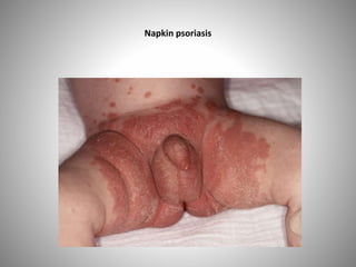 Napkin psoriasis
 