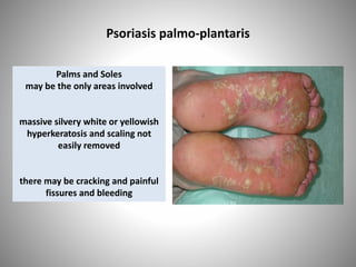 Psoriasis palmo-plantaris
Palms and Soles
may be the only areas involved
massive silvery white or yellowish
hyperkeratosis and scaling not
easily removed
there may be cracking and painful
fissures and bleeding
 