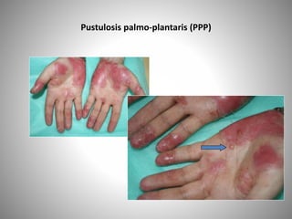 Pustulosis palmo-plantaris (PPP)
 