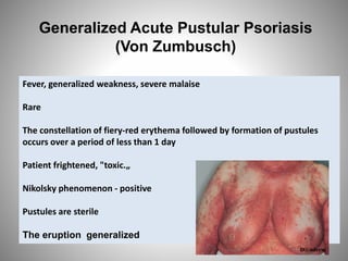 Generalized Acute Pustular Psoriasis
(Von Zumbusch)
Fever, generalized weakness, severe malaise
Rare
The constellation of fiery-red erythema followed by formation of pustules
occurs over a period of less than 1 day
Patient frightened, "toxic.„
Nikolsky phenomenon - positive
Pustules are sterile
The eruption generalized
 