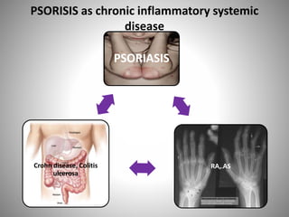 PSORIASIS
RA, ASCrohn disease, Colitis
ulcerosa
PSORISIS as chronic inflammatory systemic
disease
 