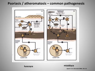 Psoriasis / atheromatosis – common pathogenesis
Spach F. Br J Dermatol 2008, 159, 10.
łuszczyca miażdżyca
 