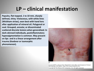 LP – clinical manifestation
Papules, flat-topped, 1 to 10 mm, sharply
defined, shiny. Violaceous, with white lines
(Wickham striae), seen best with hand lens
after application of mineral oil. Polygonal or
oval. Grouped, annular, or disseminated
scattered discrete lesions when generalized. In
dark-skinned individuals, postinflammatory
hyperpigmentation is common. May present
on lips and in a linear arrangement after
trauma (Koebner or isomorphic
phenomenon).
 
