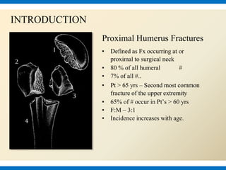 Proximal Humerus Fractures
▪ Defined as Fx occurring at or
proximal to surgical neck
▪ 80 % of all humeral #
▪ 7% of all #..
▪ Pt > 65 yrs – Second most common
fracture of the upper extremity
▪ 65% of # occur in Pt’s > 60 yrs
▪ F:M – 3:1
▪ Incidence increases with age.
INTRODUCTION
 
