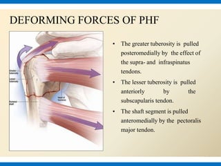 DEFORMING FORCES OF PHF
▪ The greater tuberosity is pulled
posteromedially by the effect of
the supra- and infraspinatus
tendons.
▪ The lesser tuberosity is pulled
anteriorly by the
subscapularis tendon.
▪ The shaft segment is pulled
anteromedially by the pectoralis
major tendon.
 