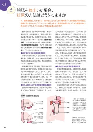 10
5
Q
図表7
これを尿道につなぐ方法です。ストーマなどの
装具をつける必要がなく、手術前と同じように
尿道から尿を出すことができます。尿意は感
じませんので、４～５時間に1度程度、定期的
に腹圧をかけて尿を出さなければなりません
が、外見上は手術前と変わらないのが利点です。
　ただ、欠点はストーマを使う方法に比べて
手術時間が長く術式が比較的難しいことです。
また、尿道にがんが広がっていて尿道を切除
した人にはこの方法は使えません。腸閉塞が
あったり腸の手術をしたことがある人も、腸を
使って新膀胱をつくることができないのでスト
ーマを使った方法を選ぶことになります。
●負担の少ない尿管皮膚瘻造設術
　尿管皮膚瘻造設術は、尿管を切断して直接
皮膚に尿管を縫いつけ、尿の出口としてスト
ーマをつくる方法です。手術方法が単純で負
担の少ない方法ですが、尿をためるパウチを
つけなければいけないことと、ストーマ合併症
などのトラブルが多いのが難点です。
　どの尿路変向術でも再発率に差はありませ
ん。複数の方法から選べる場合には、担当医
や看護師に利点と欠点をよく聞き、自分の生
　膀胱を摘出する手術を受けた場合、新たに
尿の出口をつくる尿路変向（変更）術を受け
る必要があります。尿路変向術には、主に、
尿の出口であるストーマをつける回腸導管造
設術、ストーマを使わず新たに膀胱を再建す
る自排尿型新膀胱造設術、そして、尿管を切
断して直接皮膚に縫いつける尿管皮膚瘻造設
術という3つの方法があります。
●合併症が少ない回腸導管造設術
　小腸の一部を切除して左右の尿管をつなぎ、
尿を導く回腸導管をつくり、尿の出口を腹部
の右側の皮膚に出す方法です。その出口を「ス
トーマ」と呼びます。
　回腸導管造設術（図表７）の利点は術式が
簡単で合併症が少なく、新膀胱をつくる方法
より手術時間が短くて済むことです。しかし、
ストーマの先に尿をためるパウチをつけなけれ
ばならない不便さがあります。また、ストーマ
の周囲の皮膚はかぶれやすいので、清潔を保
ちこまめに手入れするストーマケアが重要です。
●外見上変わらない自排尿型新膀胱造設術
　自排尿型新膀胱造設術（図表８）は小腸を
使って袋状の新膀胱（代用膀胱）をつくり、
回腸導管造設術
A．膀胱を摘出したときには、尿の出口とためておく場所をつくる尿路変向術を受け、
排尿するためのリハビリテーションを行います。尿路変向術にはいくつか種類があり、
自分のライフスタイルに合わせて選ぶ必要があります。
膀胱を摘出した場合、
排尿の方法はどうなりますか
小腸の一部を切除する。切
除した小腸の片側を吻合し、
左右の尿管をつないで、回
腸導管をつくる。回腸導管
の吻合していない側を尿の
出口として、腹部の右側に
出す。腹部にできた尿の出
口をストーマという。
「膀胱がん　受診から診断、
治療、経過観察への流れ」
国立がん研究センターがん情
報サービスなどを参考に作成
腎臓
小腸
（～15cm）盲腸
虫垂
尿管
回腸導管
ストーマ
尿管を回腸導管
につなぐ
小腸を
吻合する
尿管
 