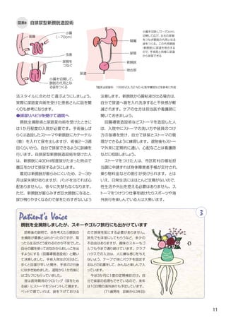 11
図表8 自排尿型新膀胱造設術
活スタイルに合わせて選ぶようにしましょう。
実際に尿路変向術を受けた患者さんに話を聞
くのも参考になります。
●排尿リハビリを受けて退院へ
　膀胱全摘除術と尿路変向術を受けたときに
は１か月程度の入院が必要です。手術後しば
らくは造設したストーマや新膀胱にカテーテル
（管）を入れて尿を出しますが、術後2〜3週
目くらいから、自分で排尿できるように訓練を
行います。自排尿型新膀胱造設術を受けた人
は、新膀胱に４００ml程度尿がたまった時点で
腹圧をかけて排尿するようにします。
　最初は新膀胱が膨らみにくいため、２～３か
月は尿失禁がありますが、パッドを当てれば心
配ありませんし、徐々に失禁もなくなります。
ただ、新膀胱が膨らみすぎ巨大膀胱になると、
尿が残りやすくなるので尿をためすぎないよう
注意します。新膀胱から腸粘液が出る場合は、
自分で尿道へ管を入れ洗浄すると不快感が軽
減されます。ケアの仕方は担当医や看護師に
聞いておきましょう。
　回腸導管造設術などストーマを造設した人
は、入院中にストーマの洗い方や装具のつけ
方の指導を受け、自分で排尿とストーマの管
理ができるように練習します。退院後もストー
マ外来に定期的に通い、心配なことは看護師
などに相談しましょう。
　ストーマをつけた人は、市区町村の福祉担
当課に申請すれば身体障害者手帳が交付され、
乗り物料金などの割引が受けられます。とは
いえ、日常生活にはほとんど支障がないので、
性生活や外出を控える必要はありません。ス
トーマをつけつつ仕事を続けたりスポーツや海
外旅行を楽しんでいる人は大勢います。
Patient's Voice 3
膀胱を全摘除しましたが、スキーやゴルフ旅行にも出かけています
　診断後の説明で、命を考えたら膀胱の
全摘除が最善とはわかったのですが、取
ったら生活がどう変わるのかが不安でした。
自分の腸を使っておなかからおしっこを出
すようにする（回腸導管造設術）と聞い
て決断しました。手術入院は20日ほど。
歩くと回復が早いと聞き、手術の2日後
には歩き始めました。退院から１か月後に
はゴルフにも行っていました。
　夜は長時間用のウロバッグ（尿をため
る袋）にストーマをジョイントして寝ます。
ベッドで寝ていれば、袋を下げておける
ので排尿を気にする必要がありません。
旅先でも洋室にしてもらうなど、多少の
不自由はありますが、趣味のスキーもゴ
ルフも今まで通り続けています。クラブ
ハウスでの入浴は、人に嫌な感じを与え
ないよう、テープで体にパウチを固定す
るなどの処置をして、みんなと楽しんで入
っています。
　今は３か月に１度の定期検診だけ。自
分で排尿の処理もできているので、来年
は10日間の海外旅行も予定しています。
(71歳男性　診断から3年目)
小腸を切除して（～70cm）、
切開して広げ、左右の尿管
をつなぎ膀胱の代用となる
袋をつくる。この代用膀胱
(新膀胱)に尿道を吻合する
ので、手術前と同様に尿道
から排尿できる
「臨床泌尿器科　1998VOL.52 NO.4」医学書院などを参考に作成
腎臓
小腸
（～70cm）
虫垂 尿管
吻合部
尿道
小腸を切開して、
膀胱の代用とな
る袋をつくる
尿管を
つなぐ
盲腸
新膀胱
 