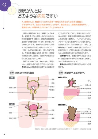 4
にがんがとどまっており、筋層には広がってい
ない状態で、筋層非浸潤性膀胱がんと呼ぶこ
ともあります（図表2）。イソギンチャクかカリ
フラワーのように表面がぶつぶつ盛り上がり、
乳頭状になっているのが特徴です。また、上
皮内がんは、表面には腫瘍が盛り上がらずに、
粘膜の壁に沿って悪性度の高いがん細胞が散
らばった状態になっている特殊ながんです。
　浸潤性がんは、筋層までがんが広がってお
り、膀胱の壁の外側やほかの臓器にも転移し
やすい性質を持っています。
　転移がんは膀胱の外側にがんが広がった状
態です。
　膀胱は骨盤の中にあり、腎臓でつくられ腎
盂、尿管を通ってきた尿を一時的にためておく
袋状の臓器です（図表１）。膀胱の内側は尿路
上皮という粘膜で覆われており、尿の量によっ
て伸縮しています。膀胱がんの90％はこの尿
路上皮の細胞ががん化し成長したものです。
　男女とも60歳以降に増え、男性のほうが多
く、男性の患者数は女性の4倍です。初期症
状は痛みのない血尿で、８割の人が血尿によ
ってがんが見つかっています。
　膀胱がんのタイプは、表在性がん、浸潤性
がん、転移がんなどのタイプに分けられます。
表在性がんは膀胱表面の粘膜下結合組織まで
1 膀胱がんとは
どのような病気ですか
Q
A．膀胱がんは、腎臓でつくられた尿を一時的にためておく袋である膀胱に
できるがんです。血尿で発見されることが多く、表在性がん（筋層非浸潤性がん）、
浸潤性がん、転移がんなどのタイプに分けられます。
「膀胱がん　受診から診断、治療、経過観察への流れ」国立がん研究センターがん情報サービスなどを参考に作成
図表1 膀胱とその周囲の臓器
男性
膀胱三角部
図表2 表在性がんと浸潤性がん
前立腺
尿管口
膀胱
尿管
尿道
女性
膀胱
尿管
尿管口
卵巣
尿道
がん
粘膜上皮
粘膜下結合組織
筋層
漿膜
脂肪
がん
粘膜下結合組織
筋層
漿膜
脂肪
粘膜上皮
膀胱三角部
■表在性がん
■浸潤性がん
内尿道口
 