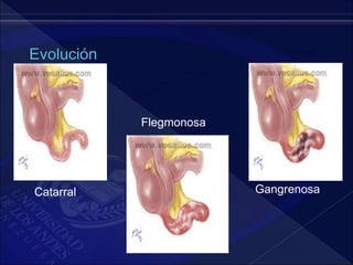 Catarral
Flegmonosa
Gangrenosa
 