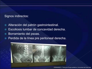 Signos indirectos:
 Alteración del patrón gastrointestinal.
 Escoliosis lumbar de concavidad derecha.
 Borramiento del psoas.
 Perdida de la línea pre peritoneal derecha.
FERNANDEZ J. Temas de Cirugía pediátrica. Universidad del Zulia 2004
 