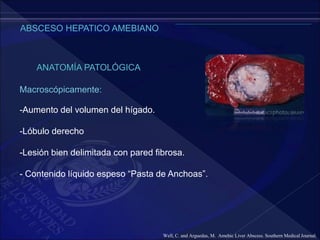 Macroscópicamente:
-Aumento del volumen del hígado.
-Lóbulo derecho
-Lesión bien delimitada con pared fibrosa.
- Contenido líquido espeso “Pasta de Anchoas”.
Well, C. and Arguedas, M. Amebic Liver Abscess. Southern Medical Journal.
 