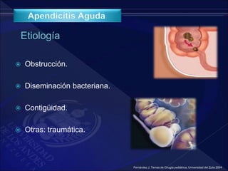  Obstrucción.
 Diseminación bacteriana.
 Contigüidad.
 Otras: traumática.
Fernández J. Temas de Cirugía pediátrica. Universidad del Zulia 2004
 