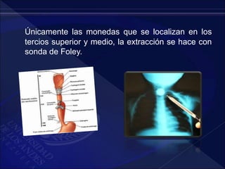 Únicamente las monedas que se localizan en los
tercios superior y medio, la extracción se hace con
sonda de Foley.
 