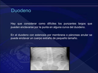 Hay que considerar como difíciles los punzantes largos que
pueden enclavarse por la punta en alguna curva del duodeno.
En el duodeno con estenosis por membrana o páncreas anular se
puede enclavar un cuerpo extraño de pequeño tamaño.
 
