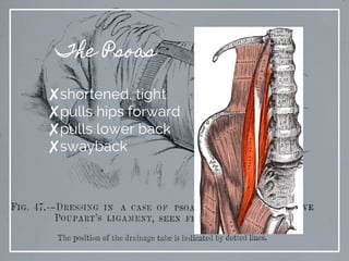 The Psoas
✘shortened, tight
✘pulls hips forward
✘pulls lower back
✘swayback
 