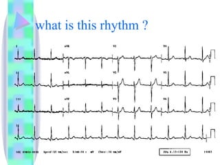what is this rhythm ? 