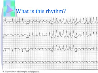 What is this rhythm? 