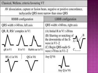 EP diagnosis of WIDE COMPLEX TACHYCARDIA | PPTX