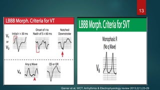 13
Garner et al, WCT. Arrhythmia & Electrophysiology review 2013;2(1):23-29
 