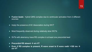  Fusion beats : hybrid QRS complex due to ventricular activation from 2 different
sources
 Imply the presence of AV dissociation during WCT
 Most frequently observed during relatively slow WCTs
 SVTs with aberrancy have RS complex in at least one precordial lead
 Precordial RS absent  s/o VT
 Even if RS complex is present, R wave onset to S wave nadir >100 ms 
s/o VT
15
 