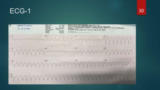 ECG-1 30
 