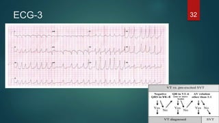 ECG-3 32
 