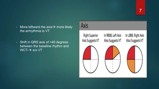 • More leftward the axis more likely
the arrhythmia is VT
• Shift in QRS axis of >40 degrees
between the baseline rhythm and
WCT- s/o VT
7
 