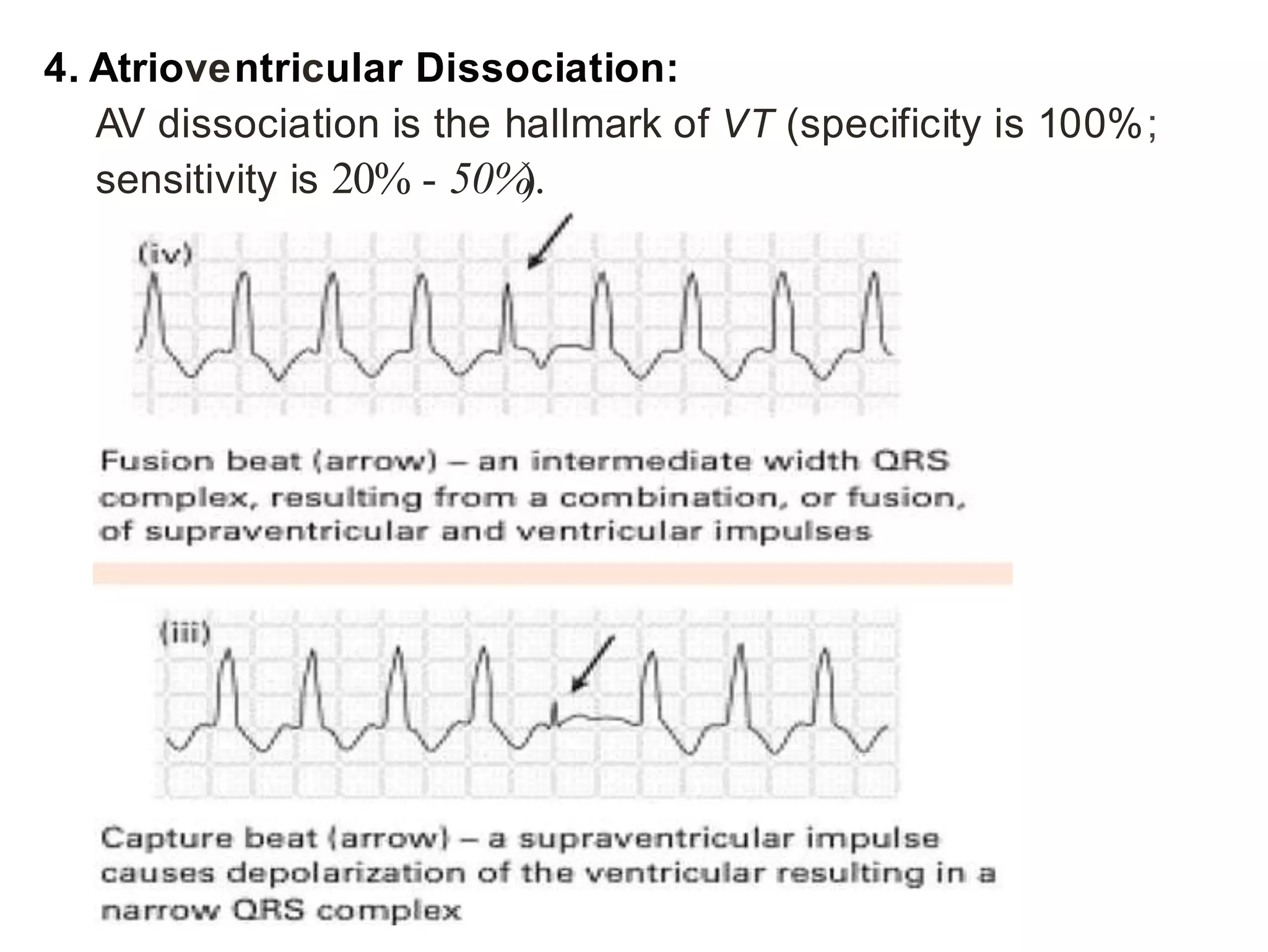 Wide QRS Complex Tachycardia VT Vs SVT PPTX Wide QRS Complex Tachycardia VT Vs SVT PPTX