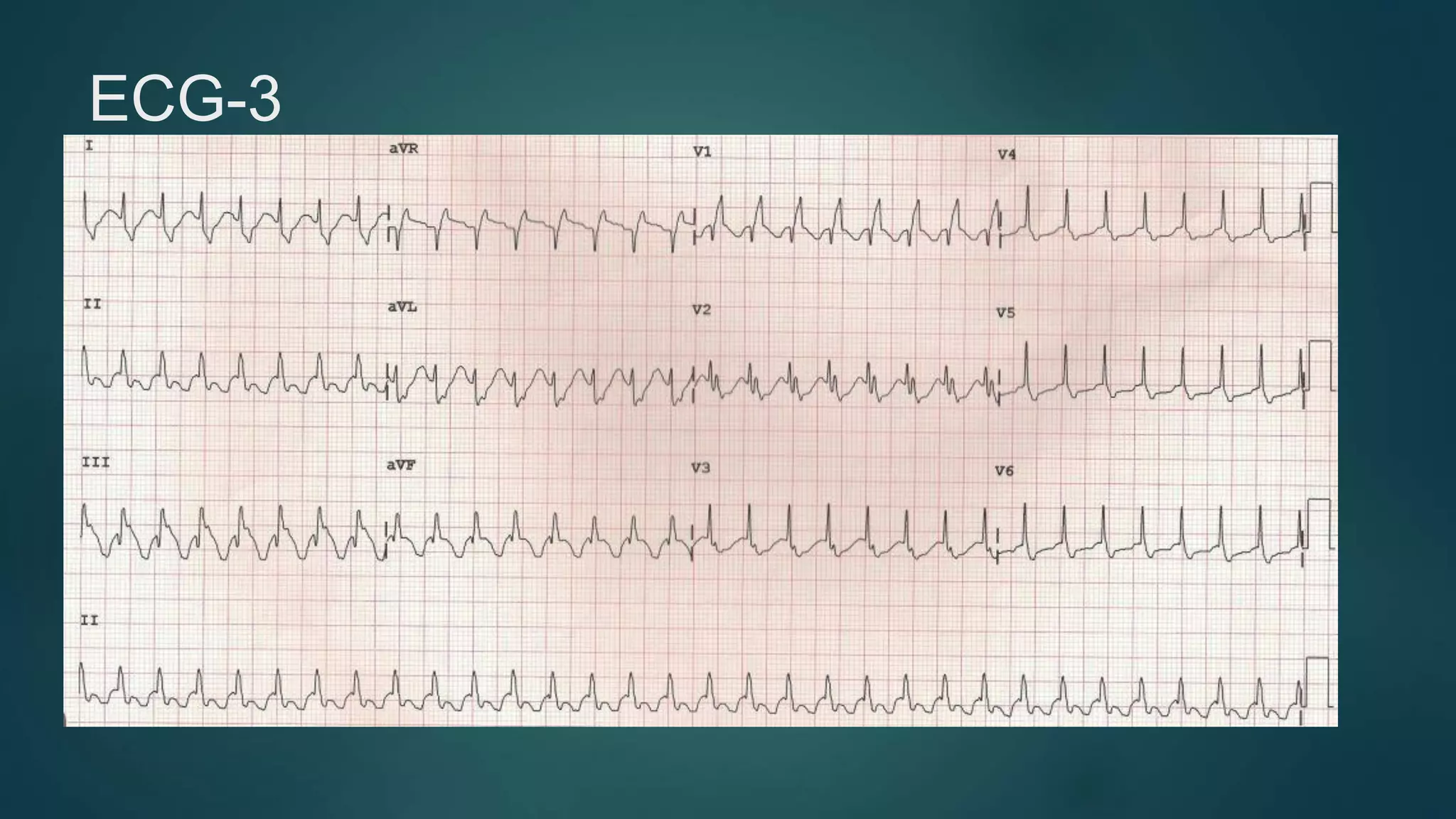 Wide complex tachycardia | PDF