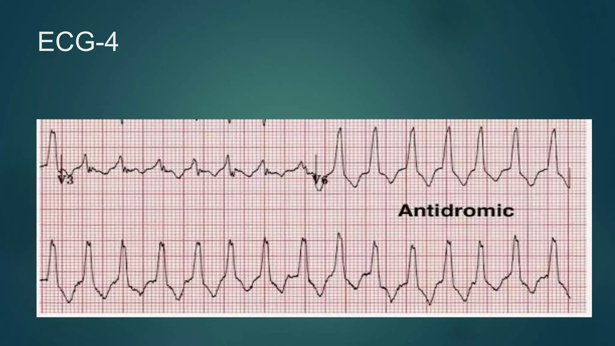 Wide complex tachycardia | PDF