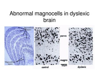 Abnormal magnocells in dyslexic
brain
 