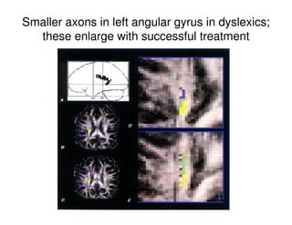 Smaller axons in left angular gyrus in dyslexics;
these enlarge with successful treatment
 
