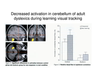 Decreased activation in cerebellum of adult
dyslexics during learning visual tracking
 
