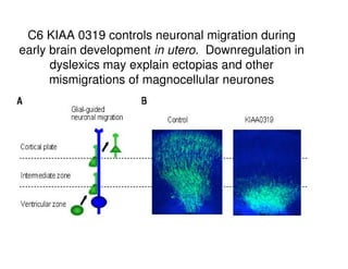 C6 KIAA 0319 controls neuronal migration during
early brain development in utero. Downregulation in
dyslexics may explain ectopias and other
mismigrations of magnocellular neurones
 
