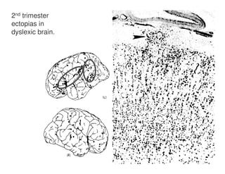2nd trimester
ectopias in
dyslexic brain.
 