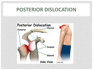 Posterior shoulder dislocation 2 | PPTX