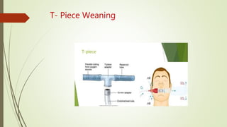 T- Piece Weaning
 