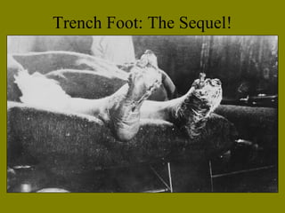 Trench Foot: The Sequel!
 