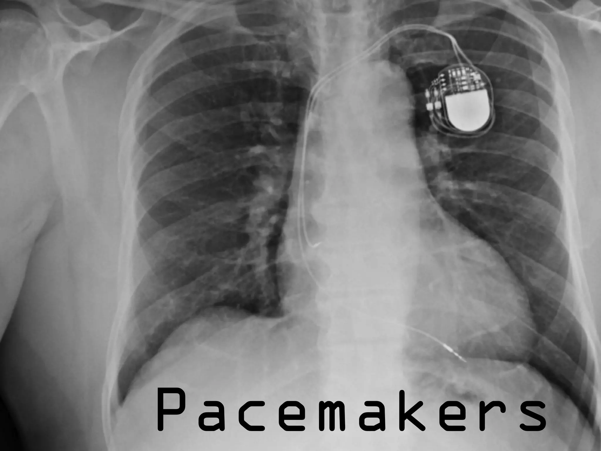 Pacemakers
 