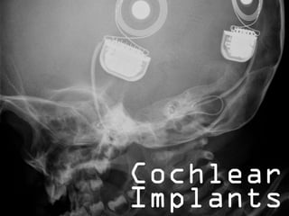 Cochlear
Implants
 