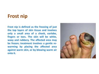 Weather injury | PPTX