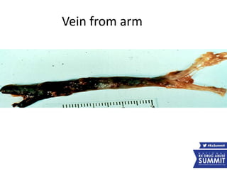 Vein from arm
 
