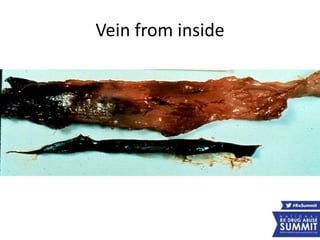 Vein from inside
 